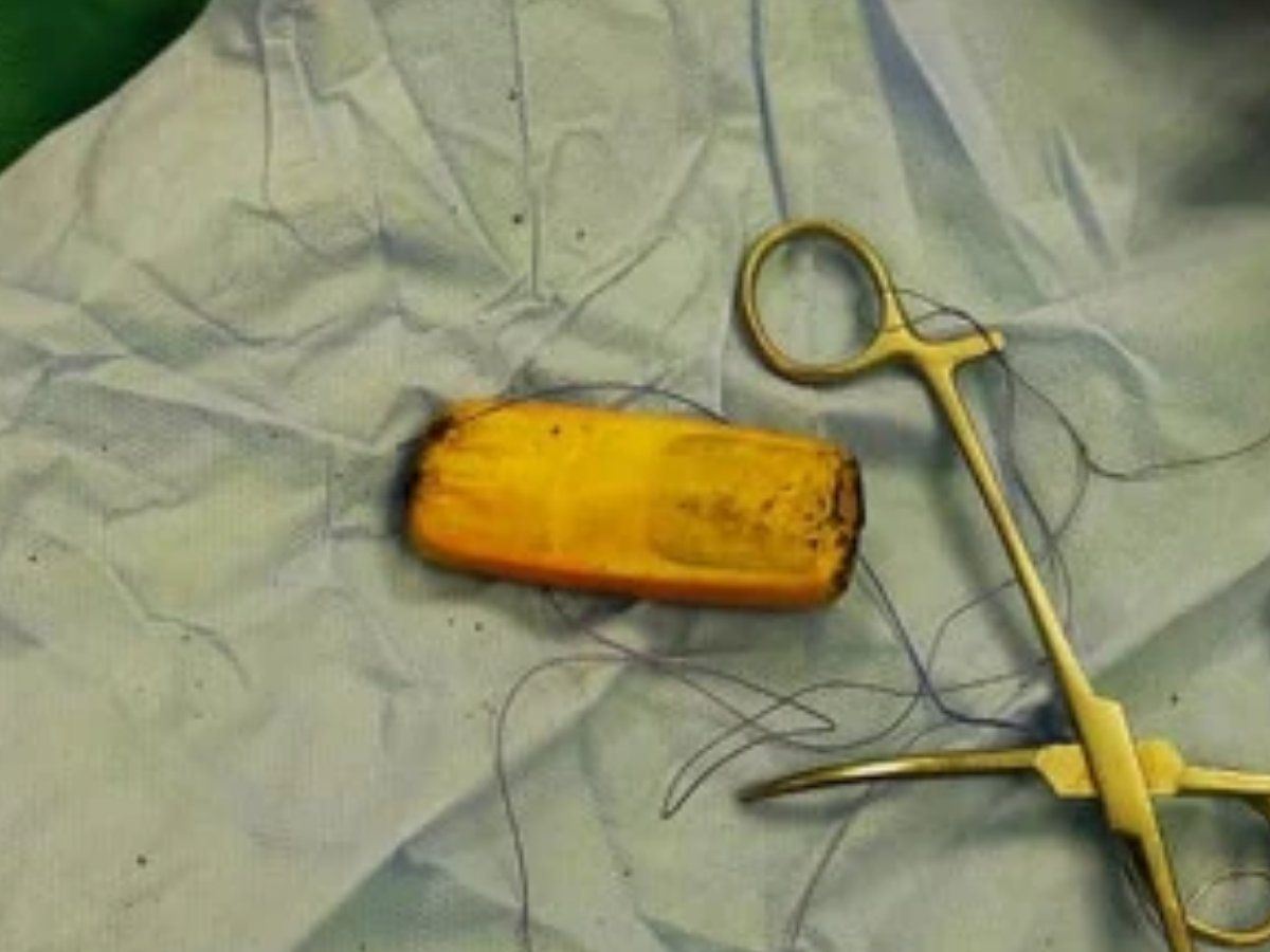 man swallows entire phone, waited 6 months for it to pass naturally through his body