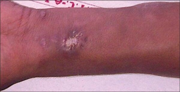 terpengaruh filem, remaja sengaja biar digigit labah-labah demi jadi spider-man