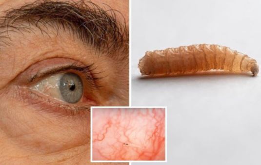 rasa gatal rupanya ada lebih sedozen ulat dalam mata lelaki ini