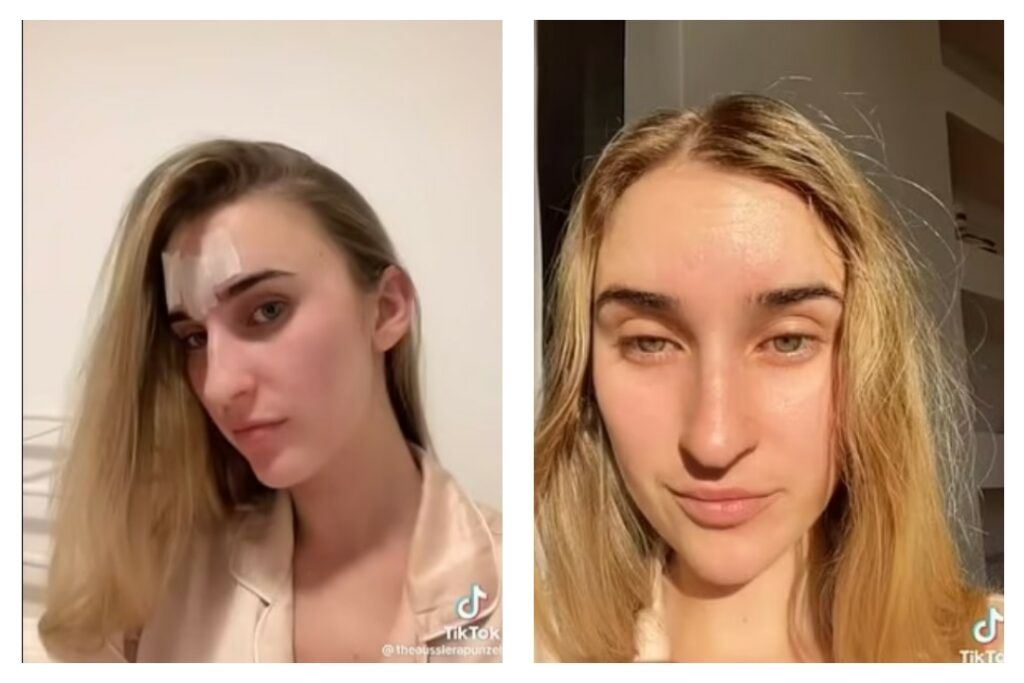 kini trend wanita lekat soletip pada dahi elak kedutan