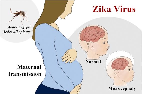 virus zika boleh sebabkan wabak baru, penyelidik kesihatan beri amaran