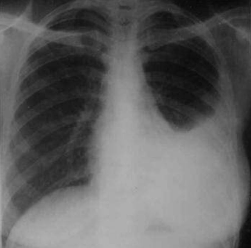 akibat merokok, paru-paru lelaki ini penuh cecair nanah!