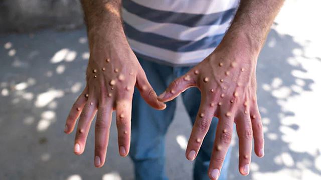 death-monkeypox-india-640.png