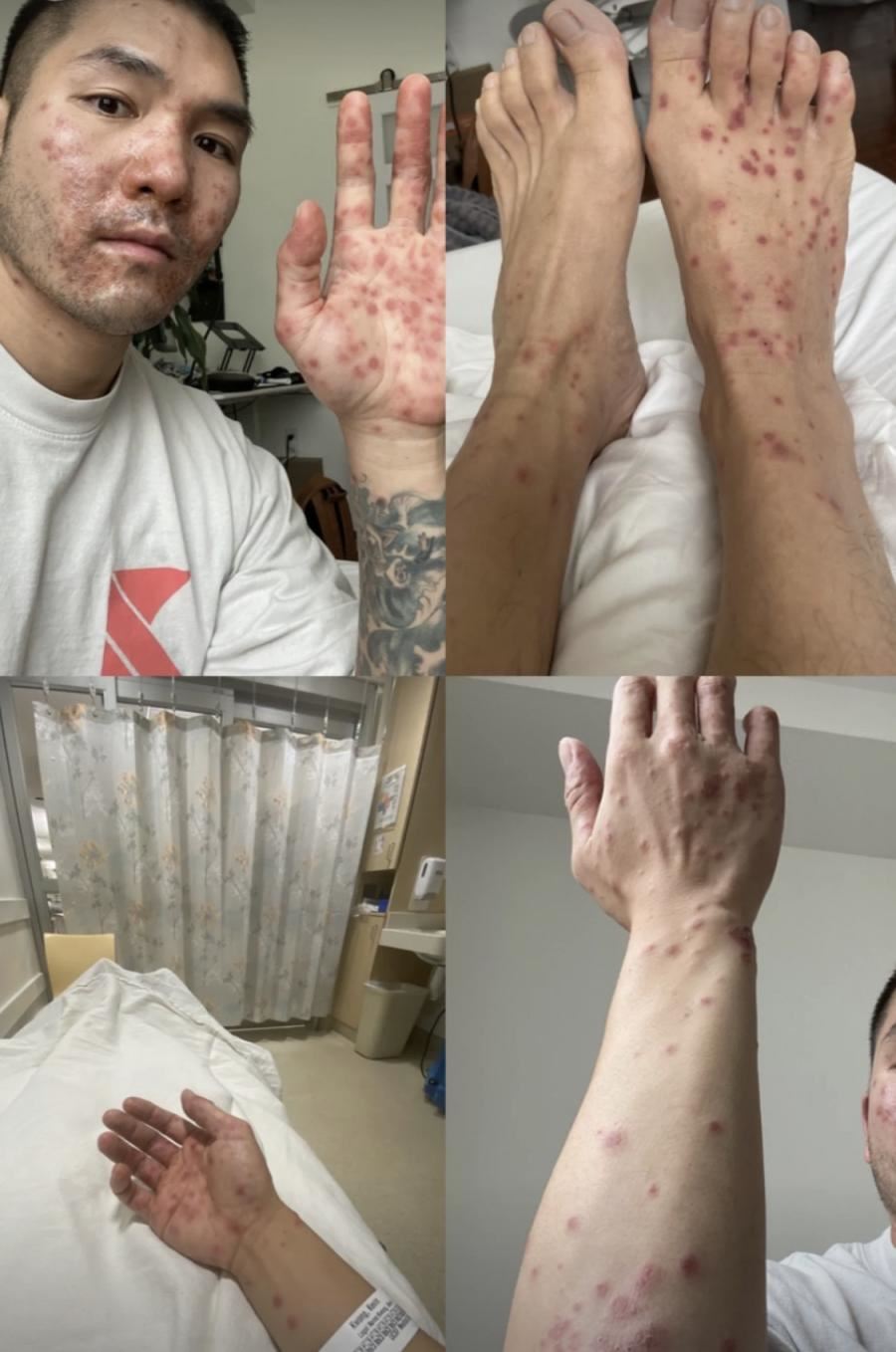 【6次误诊】亚裔男公开猴痘确诊全过程!