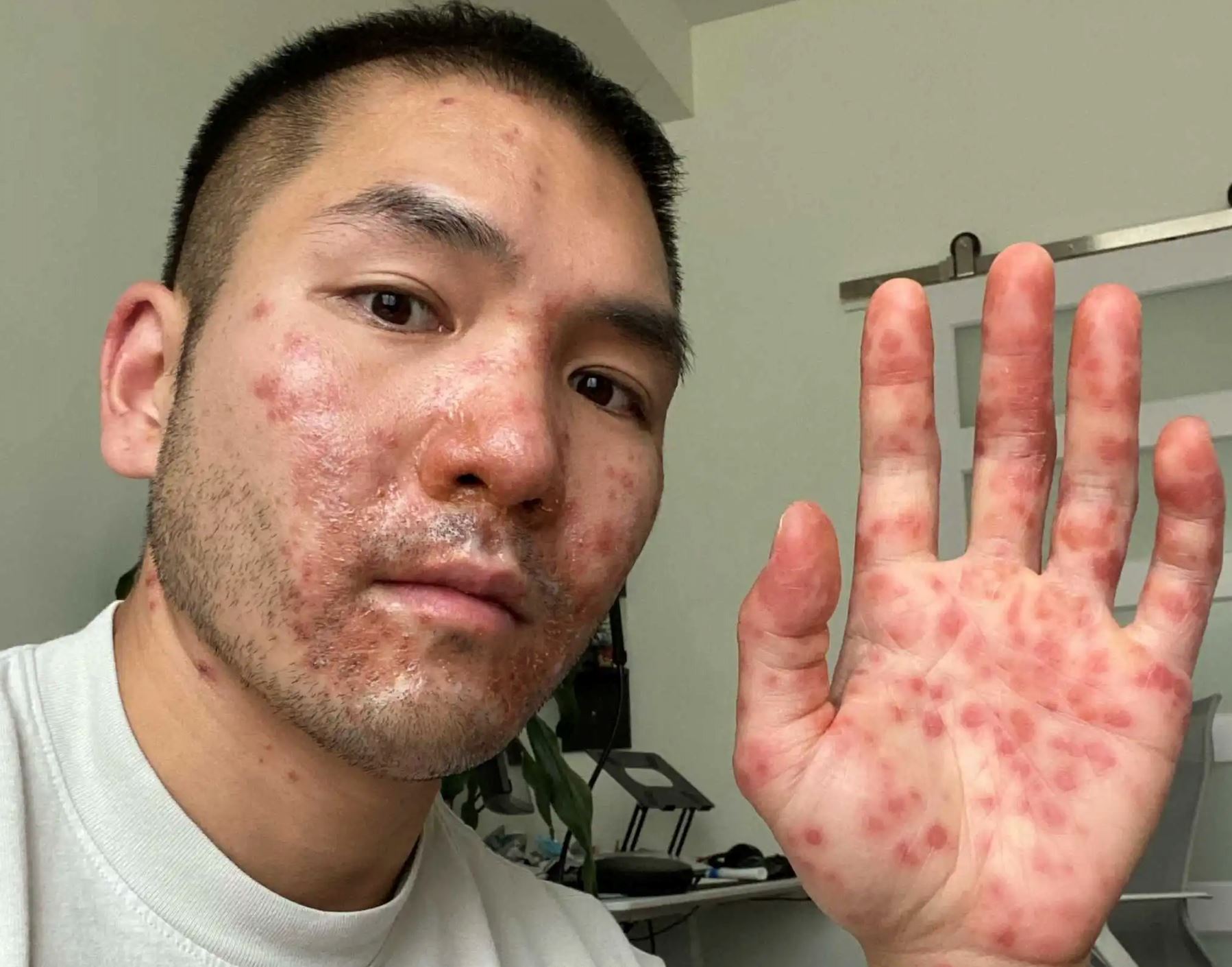 【6次误诊】亚裔男公开猴痘确诊全过程!