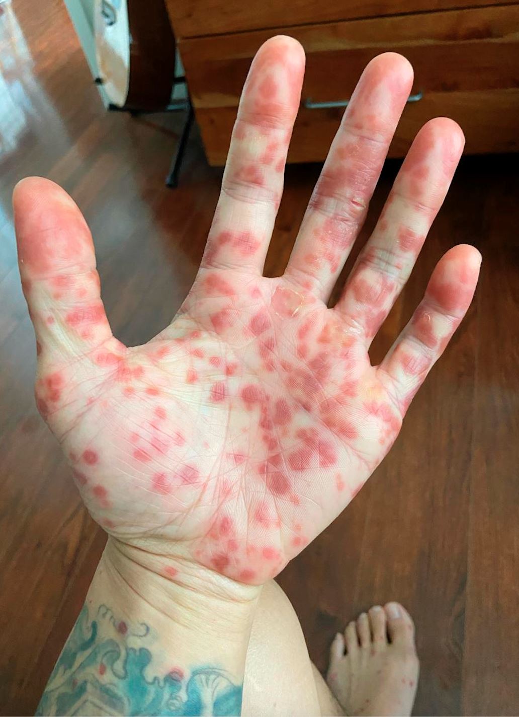 【6次误诊】亚裔男公开猴痘确诊全过程!