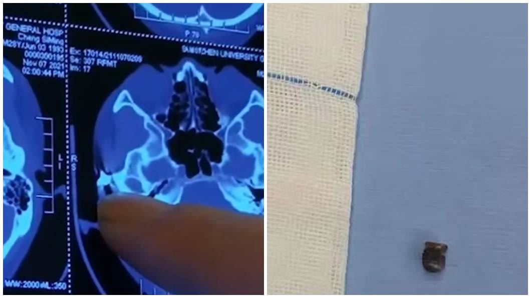 man suffers from severe headache, turns out there’s a bullet in his skull for the past 20 years