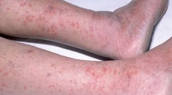 kaki dipotong akibat ambil lebihan makanan dalam peti sejuk