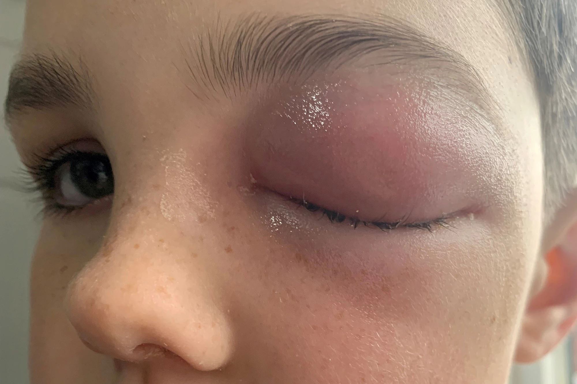 mata kiri kanak-kanak ini hampir buta akibat covid-19