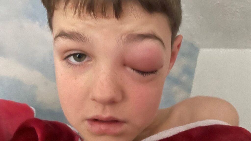 mata kiri kanak-kanak ini hampir buta akibat covid-19