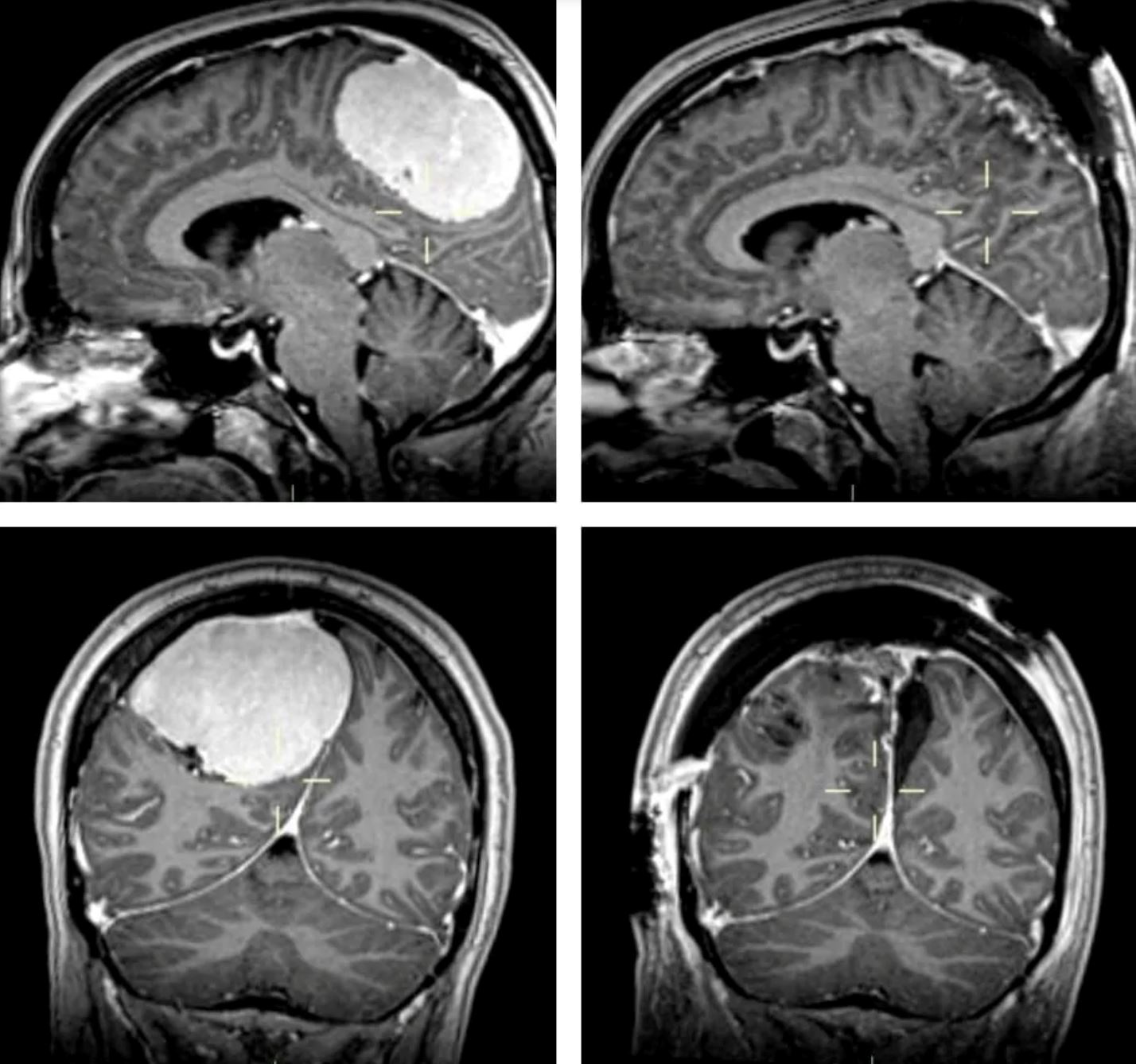 disangkakan migrain, rupanya wanita ini rupanya punya tumor sebesar 4 inci