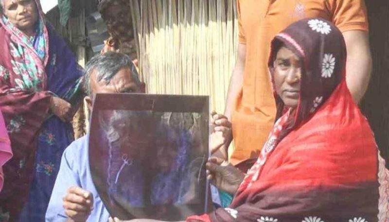 bangladeshi woman lived with surgical scissors in her abdomen for 20 years