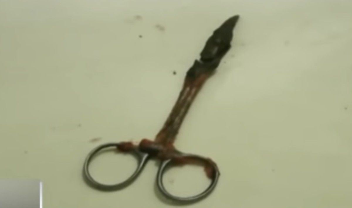 bangladeshi woman lived with surgical scissors in her abdomen for 20 years