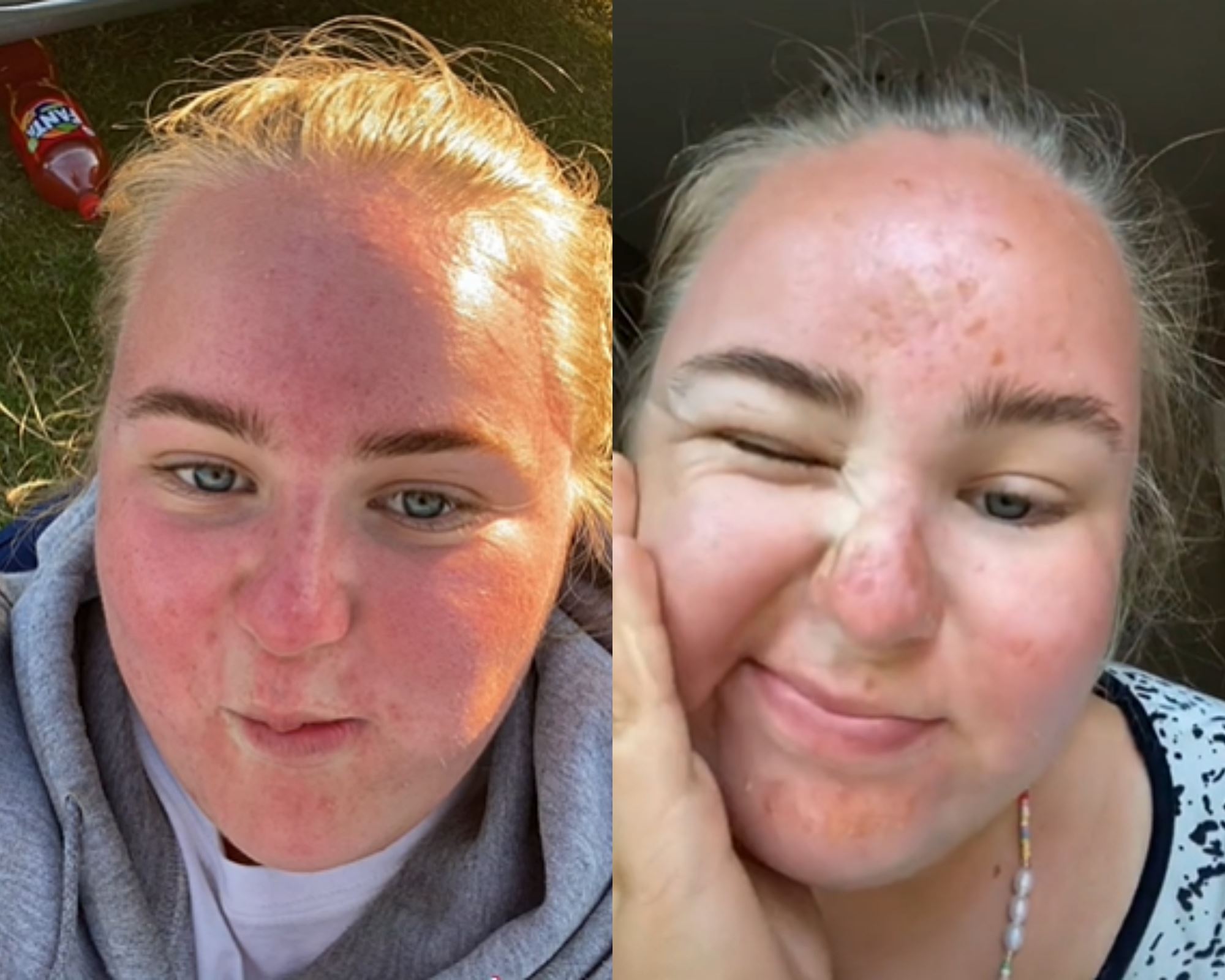 muka bengkak teruk lepas sejam terdedah terik matahari di uk