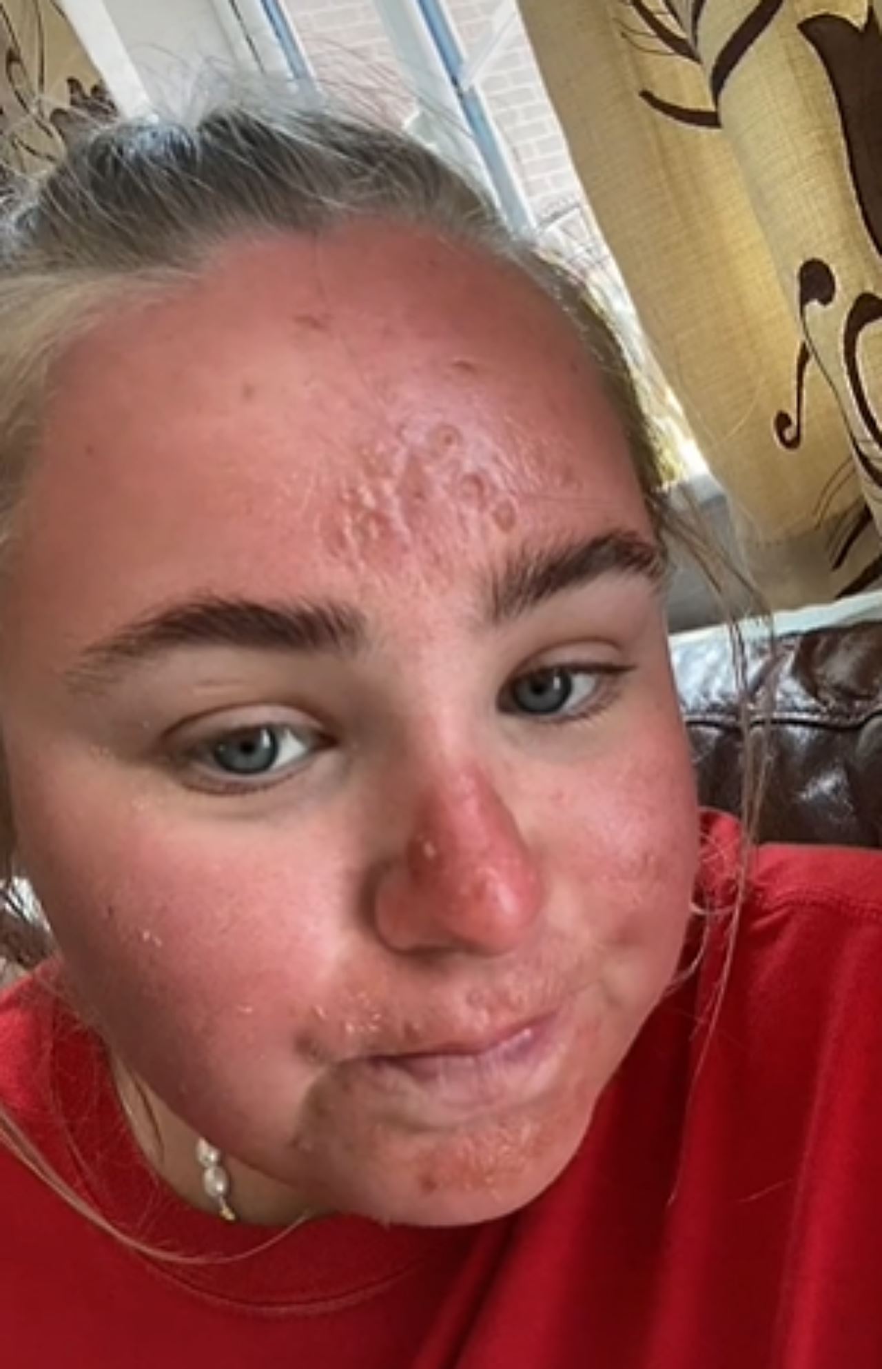 muka bengkak teruk lepas sejam terdedah terik matahari di uk