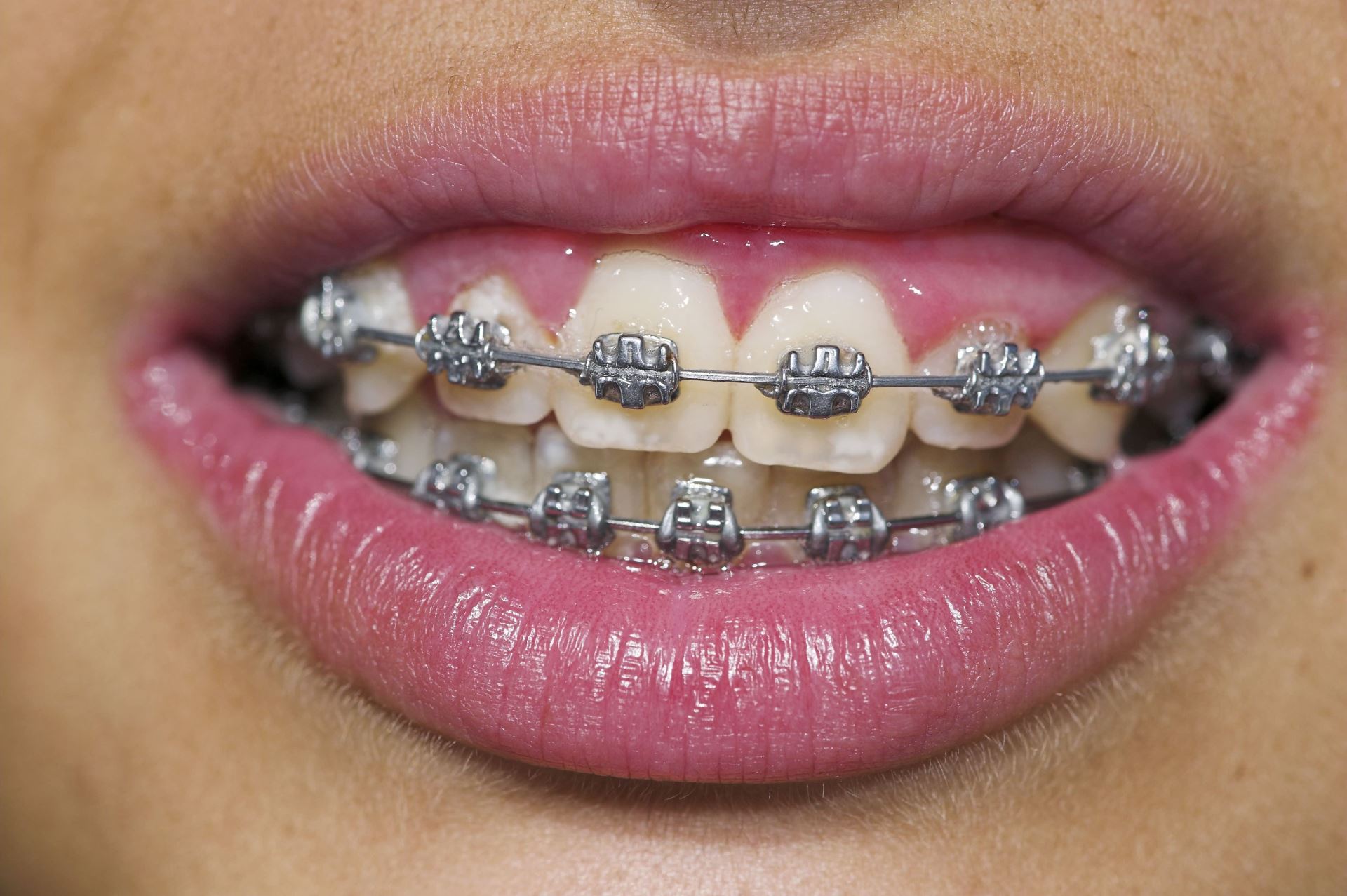 kkm investigates “certified” dentist offering rm300 braces service
