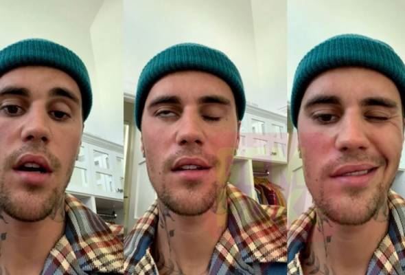kenali sindrom rasmay hunt yang dihidapi justin bieber