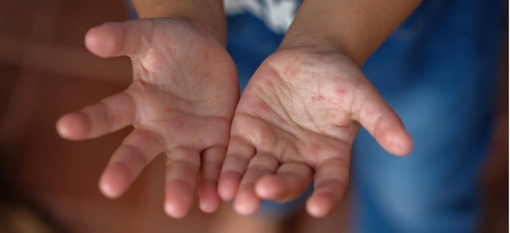 hfmd cases in johor rises 67-times compared to last year!