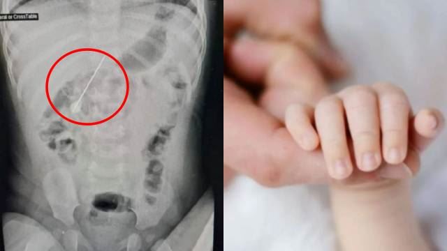 bahana tertelan jarum, bayi tujuh bulan dalam keadaan kritikal akibat jarum tusuk pada usus