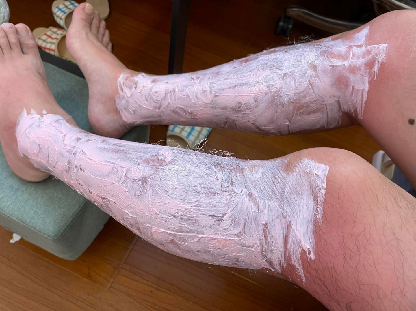 man in taiwan burns eyes and legs after leaving uv lamp on for three hours!