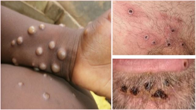 monkeypox-640_3.png