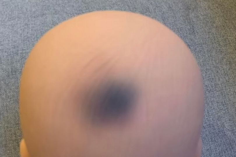 ibu risau tanda hitam pada anak patung ini makin lama makin besar