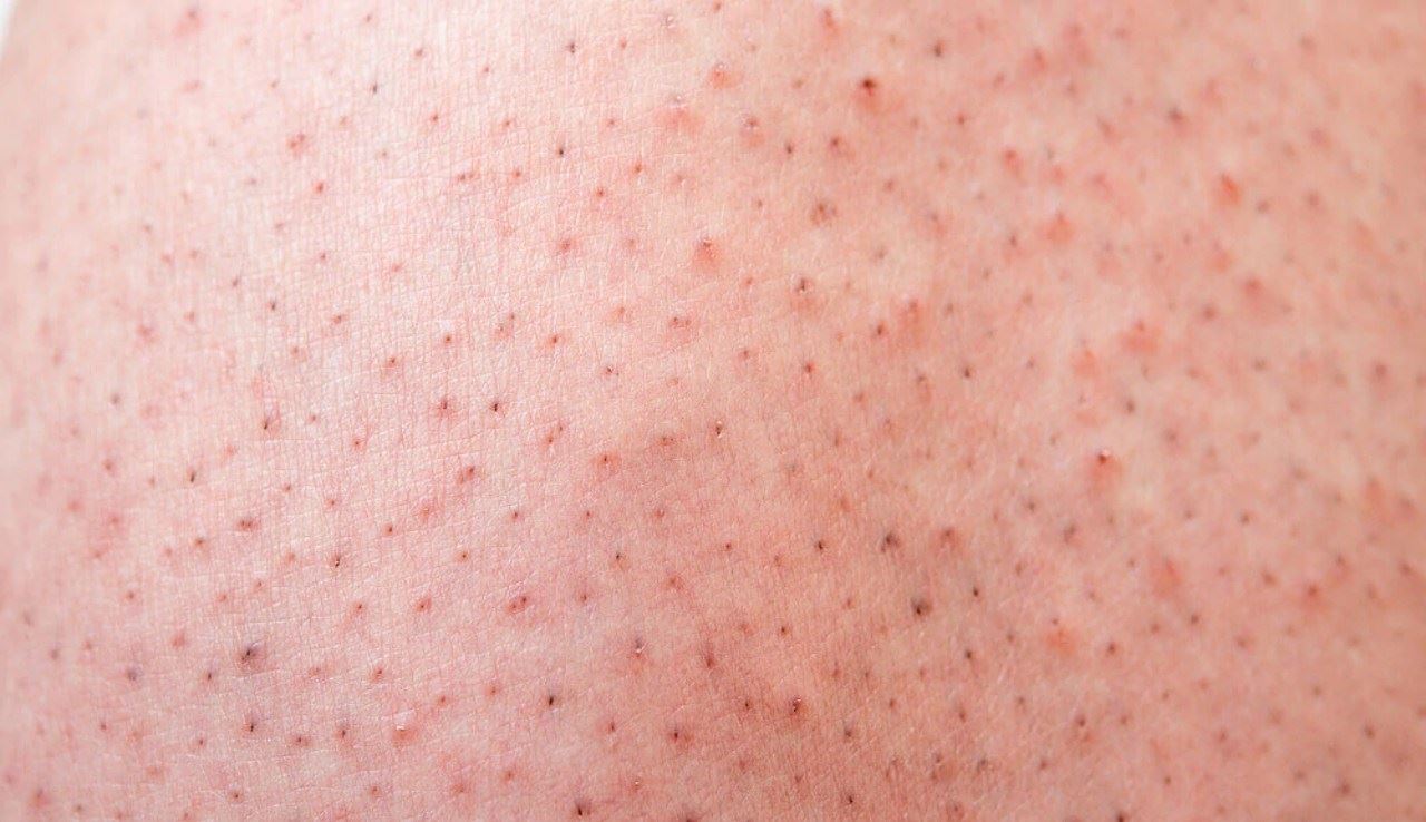 kerap mencukur antara punca terjadinya 'strawberry leg'