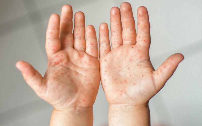 lebih baik jumpa doktor dari guna serbuk kunyit rawat hfmd