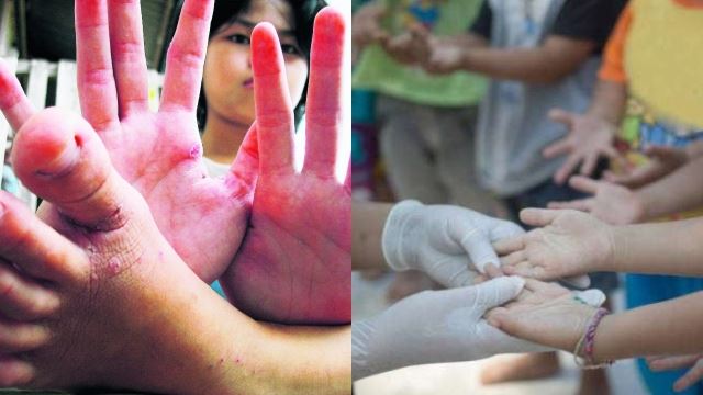 kes hfmd di negara semakin serius, meningkat 20 kali ganda