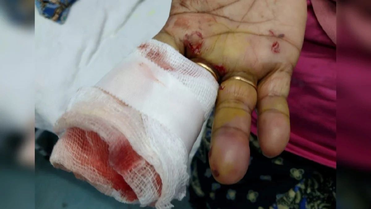 bahana mercun bola, individu tak sangka dua jari cedera ketika halau monyet