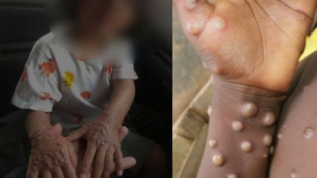 tular gambar kanak-kanak dijangkiti virus monkeypox, kkm tidak terima sebarang notifikasi kes