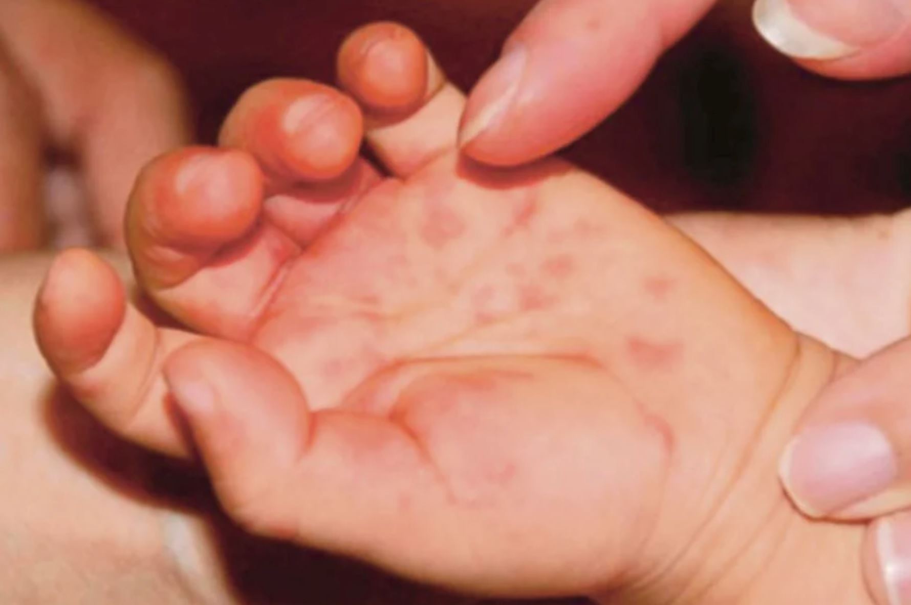 kedah, perlis records increasing number of hfmd cases