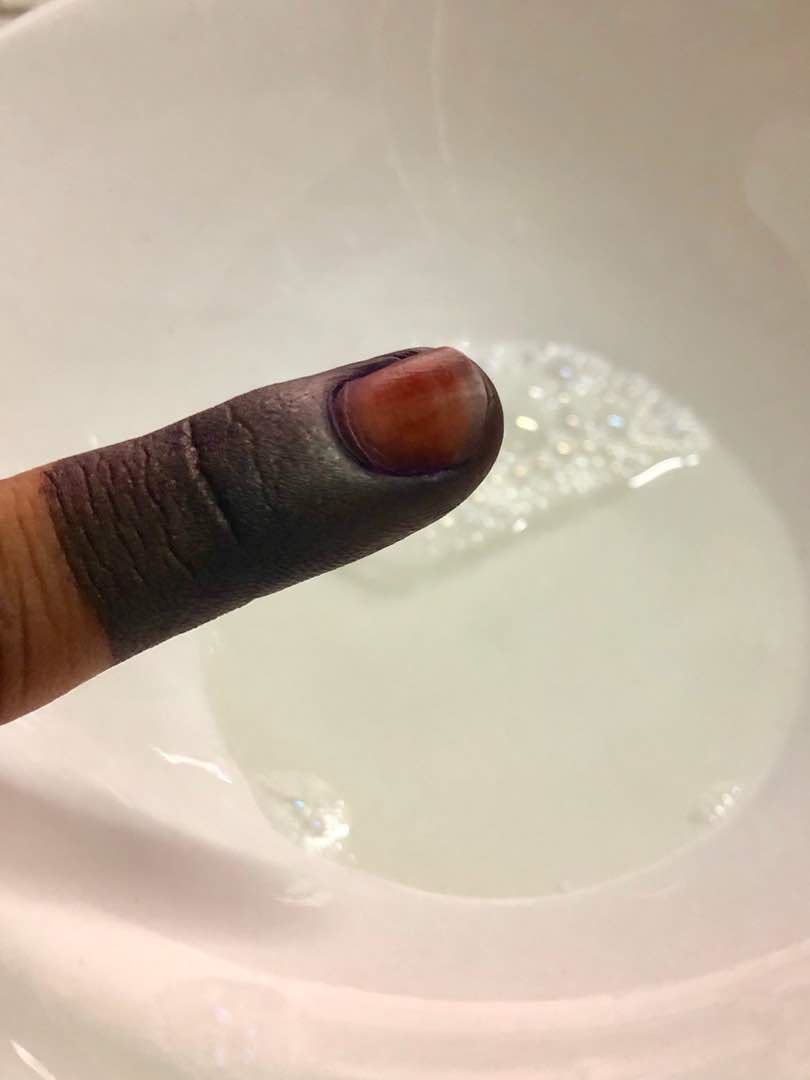 ini sebab kenapa jari ungu anda bertukar coklat lepas mengundi