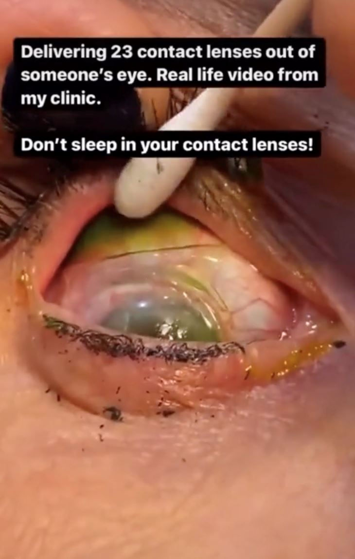 lupa dah pakai, doktor keluarkan 23 kanta sentuh dalam mata pesakit ini