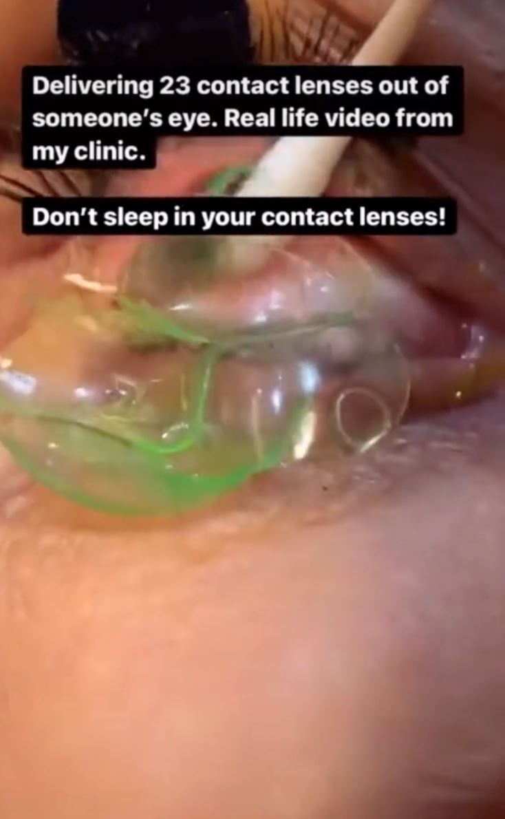 lupa dah pakai, doktor keluarkan 23 kanta sentuh dalam mata pesakit ini