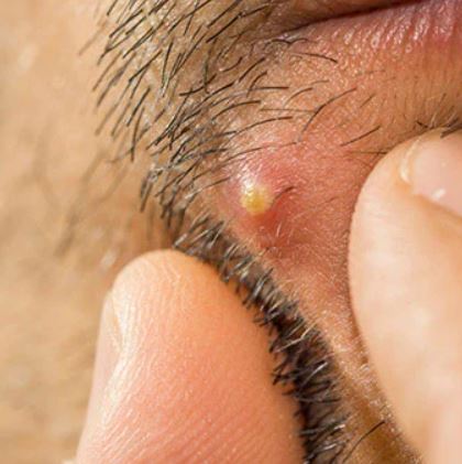 kerap mencukur, berat badan berlebihan antara punca jadi bisul, ayuh semak punca lain disini