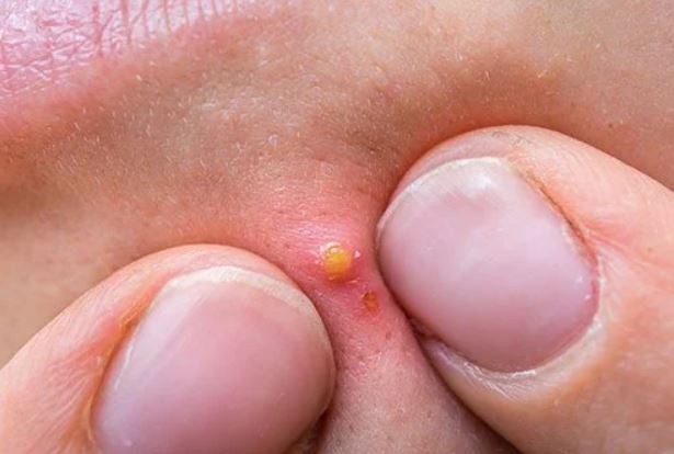 kerap mencukur, berat badan berlebihan antara punca jadi bisul, ayuh semak punca lain disini