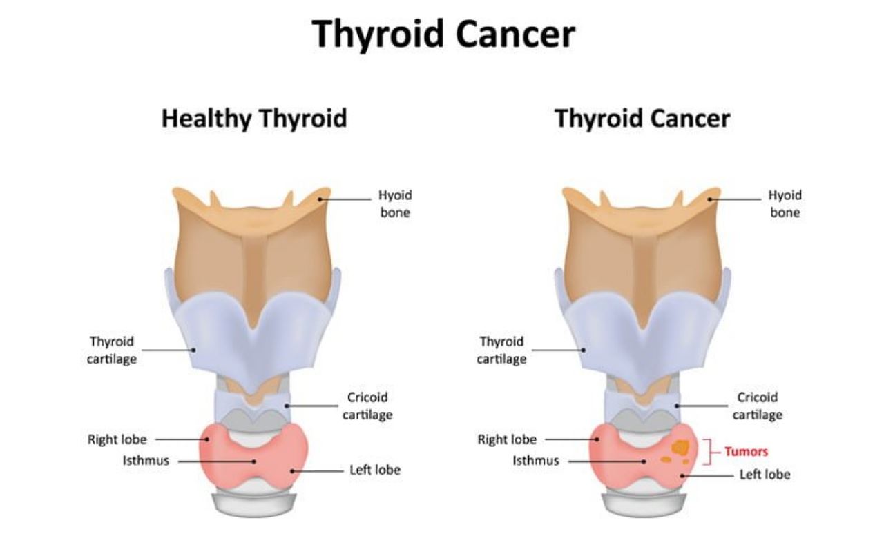 jangan anggap bengkak leher perkara biasa, lebih lagi kaum wanita