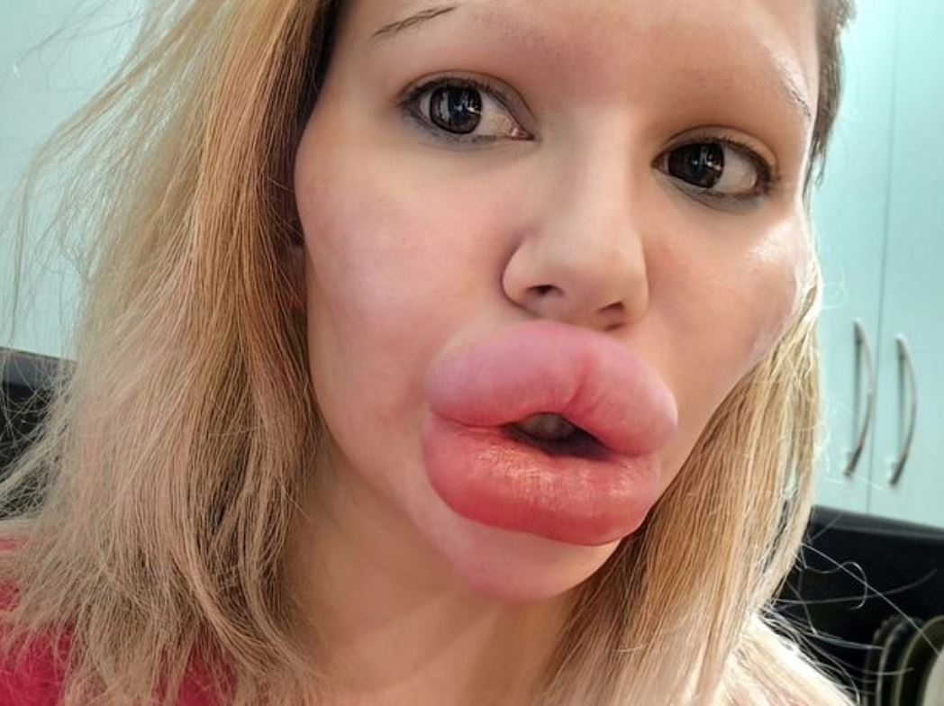 wanita bibir paling besar di dunia akui sukar cari pasangan