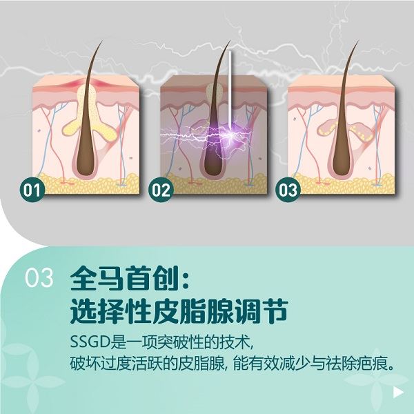 Medic Deno独家专利科技SSGM9步骤3