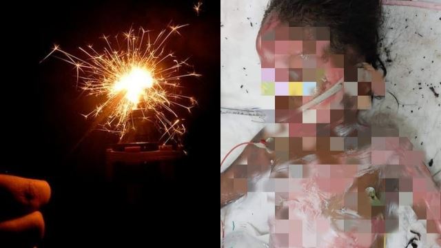 bahana bermain mercun, kanak-kanak 4 tahun melecur sebahagian badan