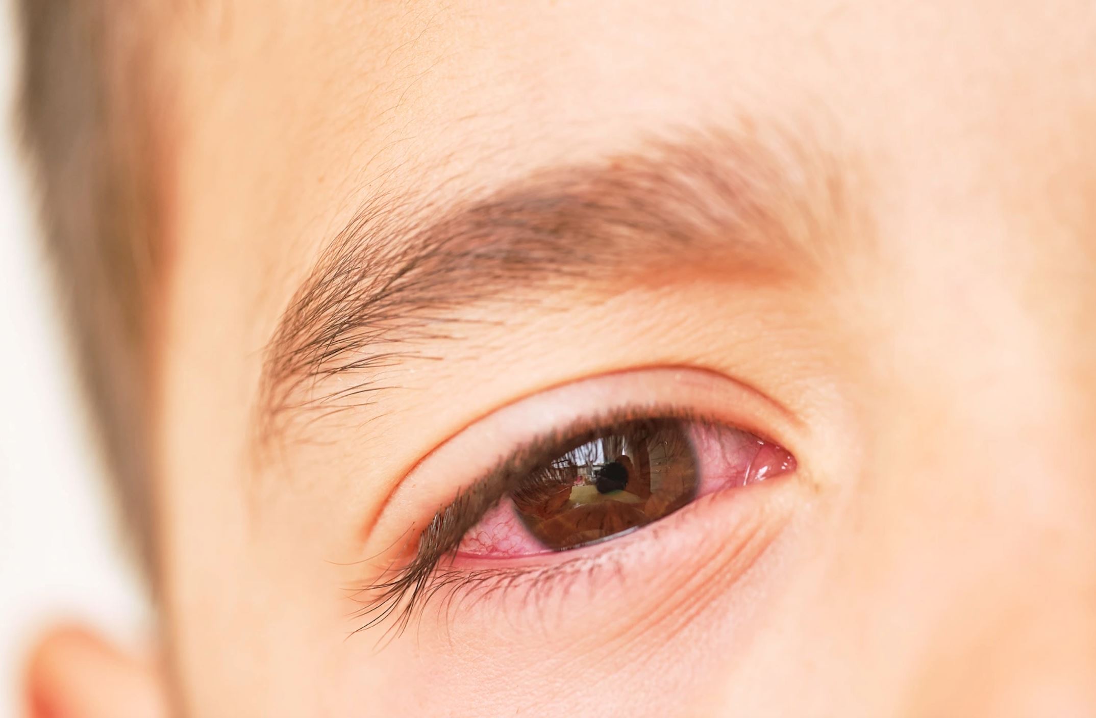 结膜炎就是感染大角星？一次看arcturus感染症状！