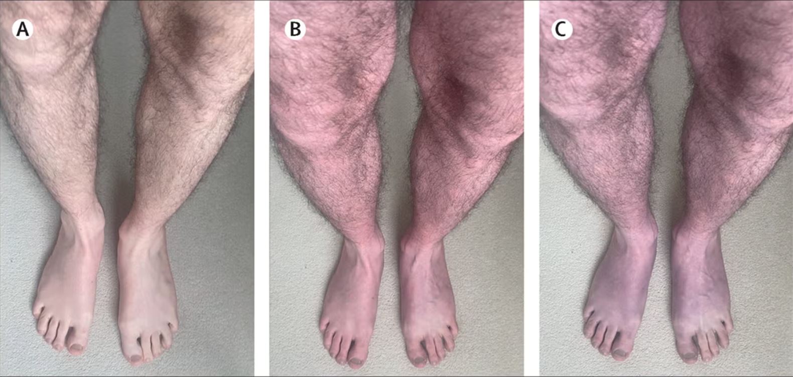 gejala ‘long-covid’ yang misteri kini dikenal pasti oleh saintis