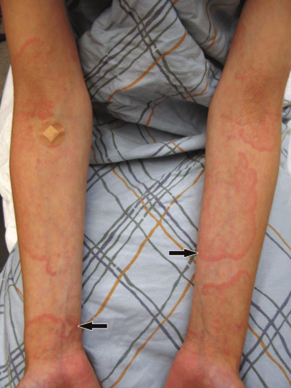 红斑狼疮症被称为「不死癌症」！6个早期征兆应留意！