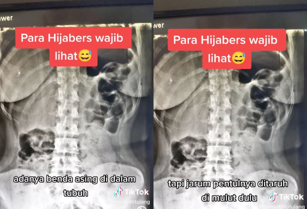 woman accidentally swallows head scarf pins, doctor advise public to not hold pins in between lips