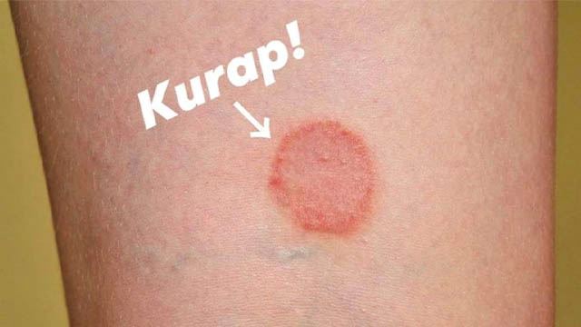 5 penyakit kulit ini terjadi ketika musim hujan