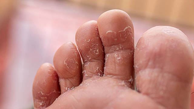 5 penyakit kulit ini terjadi ketika musim hujan