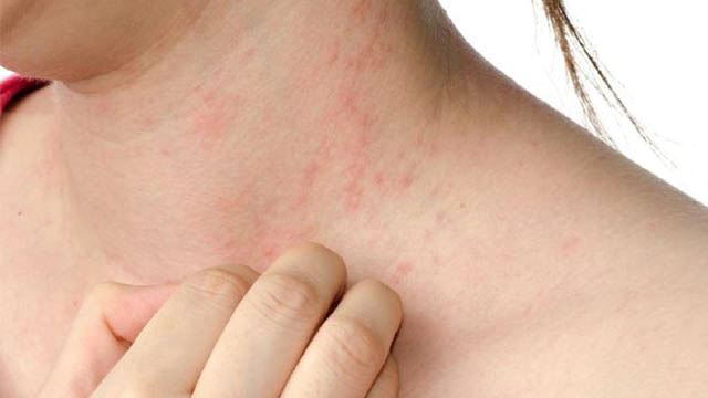 5 penyakit kulit ini terjadi ketika musim hujan