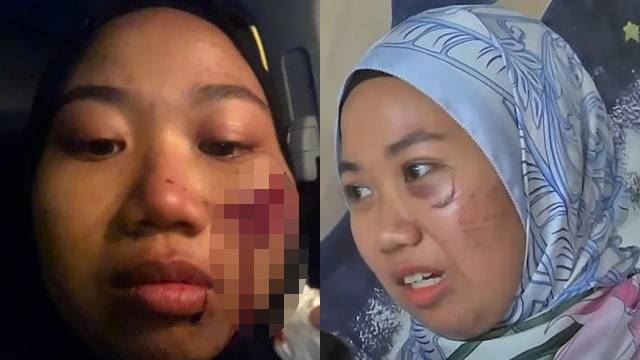 nurul shuhada dedah jahitan luka di pipi, tak mahu simpan dendam