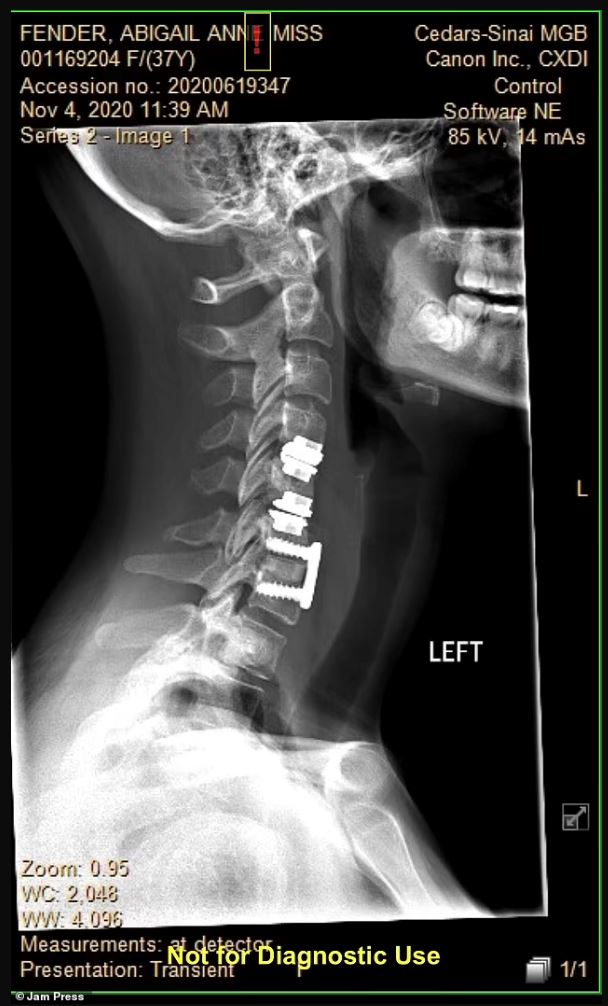 pelik! sedar dari pembedahan, wanita ini boleh cakap tiga loghat asing